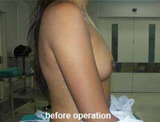 plastic-surgery-breast-augmentation 